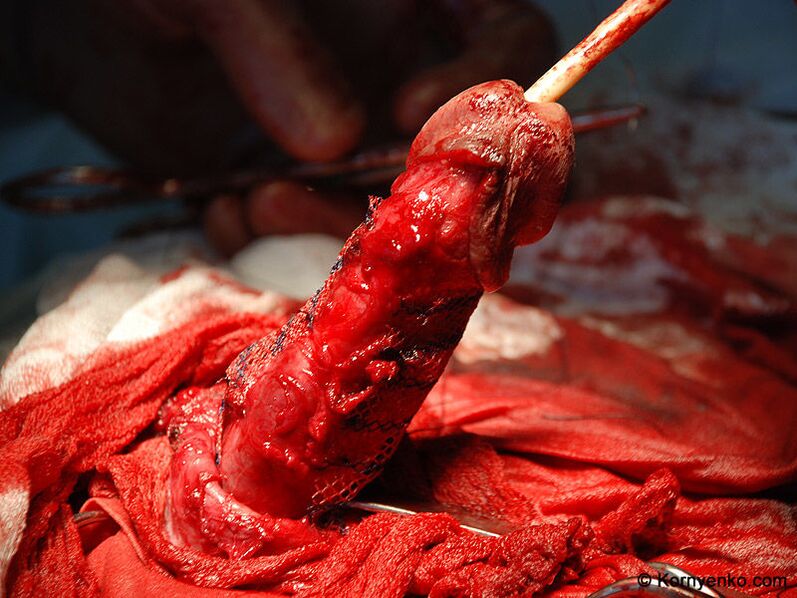 kolageno matricos įrengimas varpos didinimui