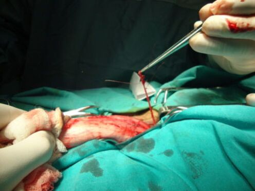 varpos didinimo operacija