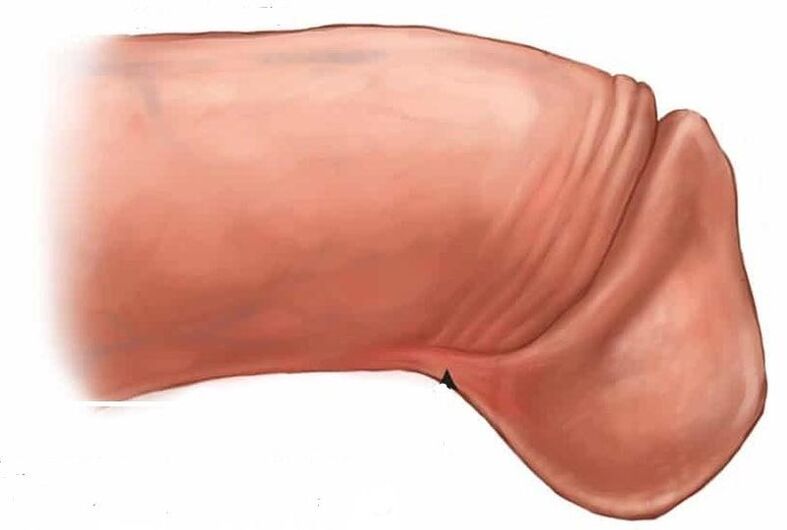 kaip padidinti varpos galvutę